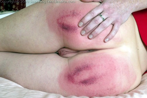 teen girl bruised bottom